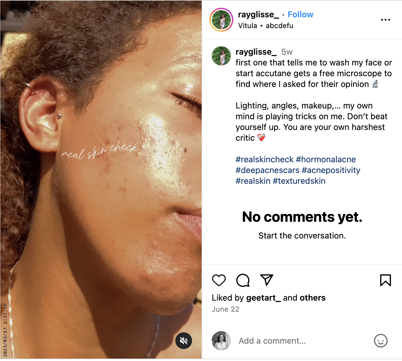 An Instagram Reel featuring a micro-influencer (one of Topicals Hype Members) showcasing her hyperpigmentation and acne scars. The video's text overlay reads 'Real Skin Check.'